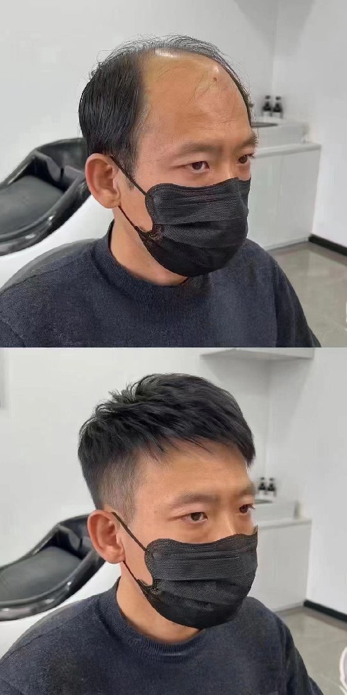 哥还是老样子，我却是样子老？南阳千丝美补发假发定制助我重拾年轻面貌