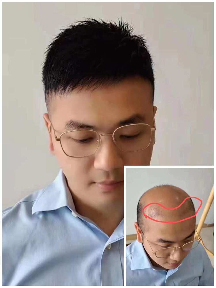 同学聚会再见老同学，南阳千丝美补发假发助你“逆龄”赴约