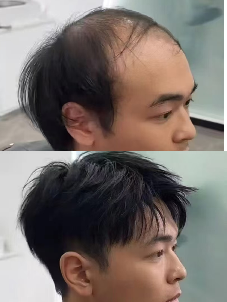 ​脱发别认输！换个思路做型男，南阳千丝美助你开启“高光时刻”​