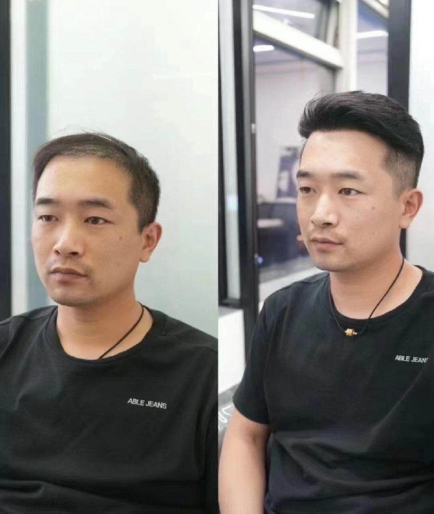 脱发别乱吃生发药！这味中药吃多会要命！