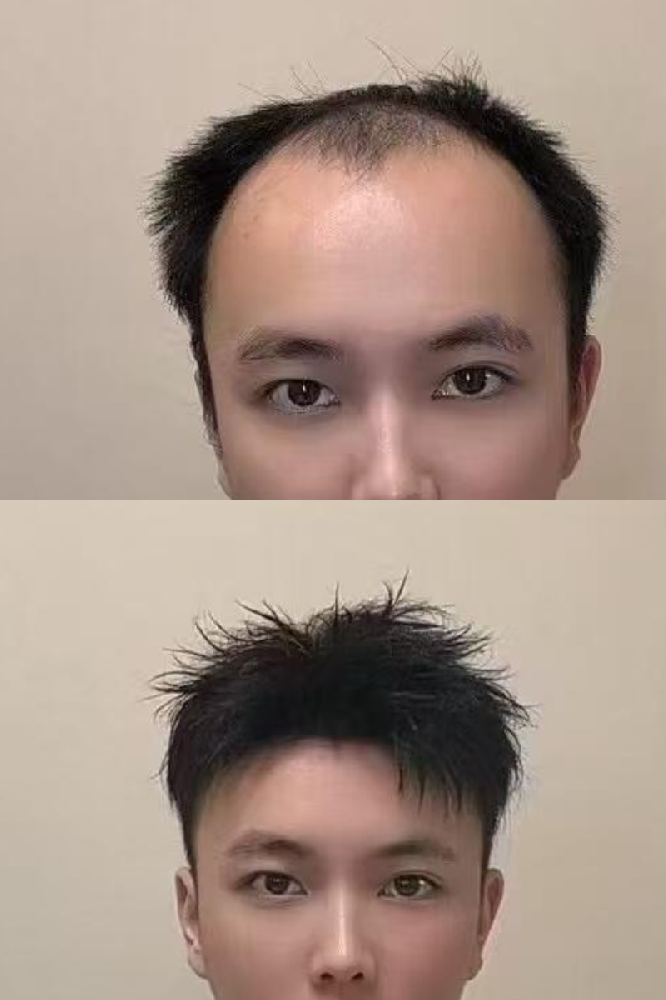 南阳脱发男士如何拥有理想发型？真人发假发订做帮你实现梦想。
