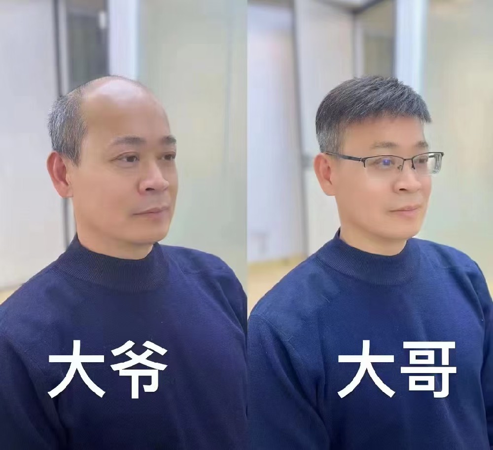 天生头发稀少怎么变浓密？南阳千丝美补发假发定制来告诉您