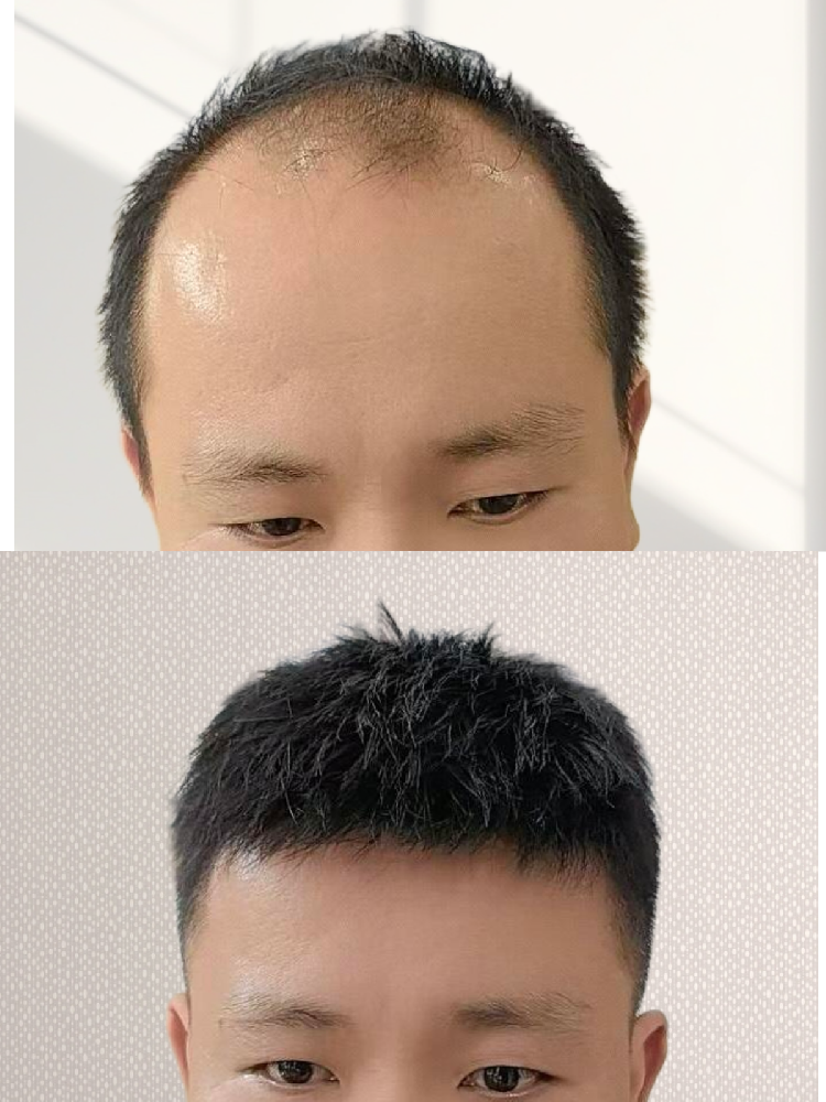 脱发了，着手改变从“头”开始