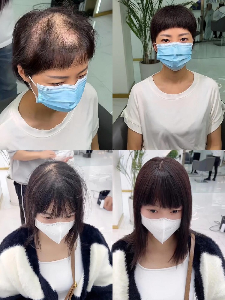 南阳千丝美：帮您解决头发稀疏的困扰