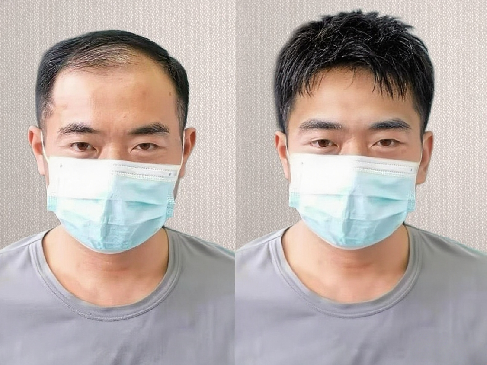 让稀疏头发重现浓密——南阳千丝美为您找回自信