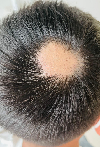 斑秃困扰不用愁，补发带来新希望