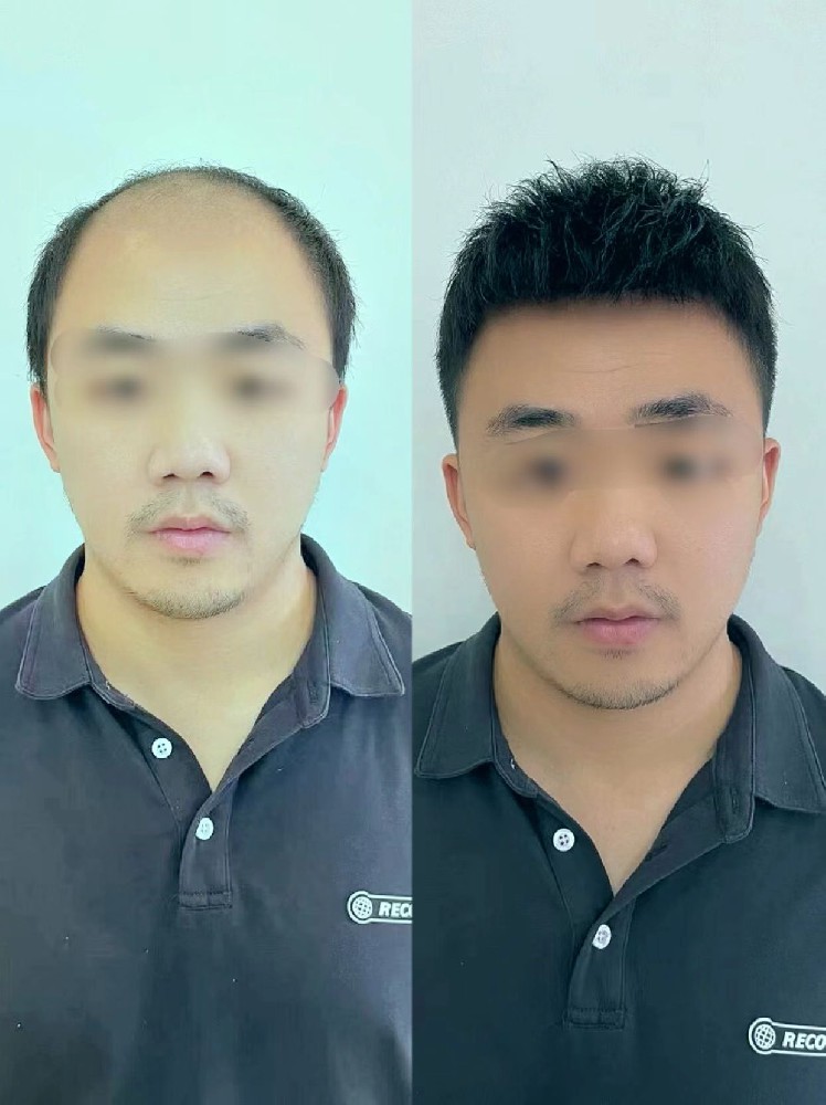 在南阳，如何选一顶合适的男士假发？