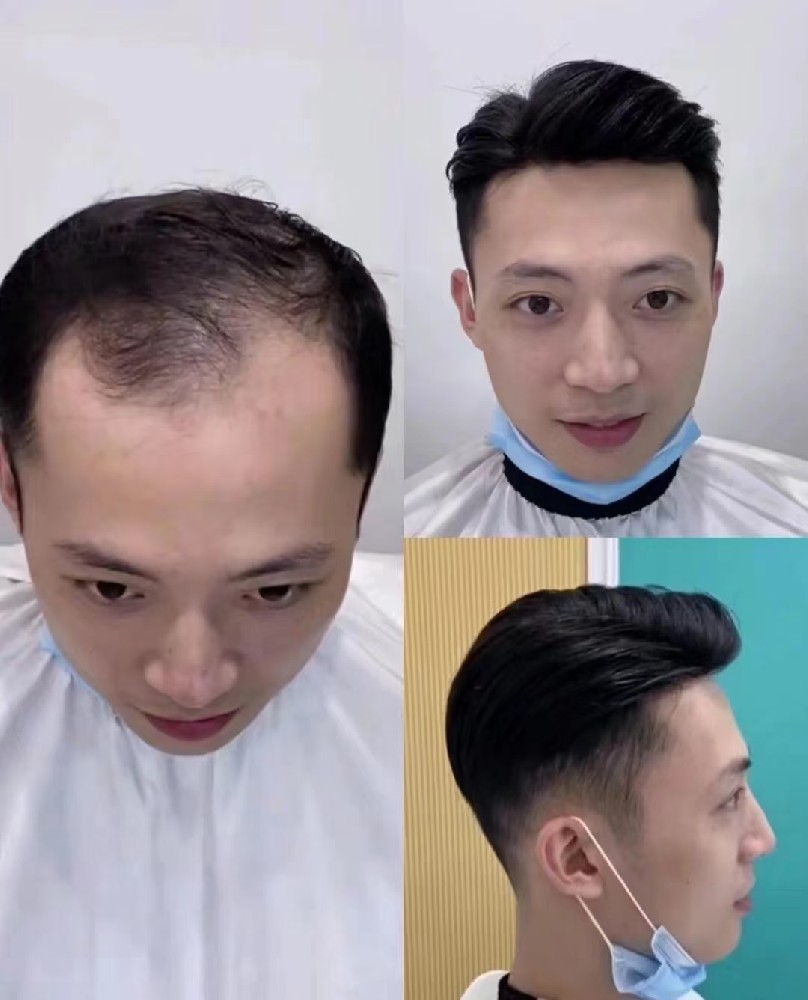 南阳千丝美补发定制中心：告别脱发困扰，重拾自信人生