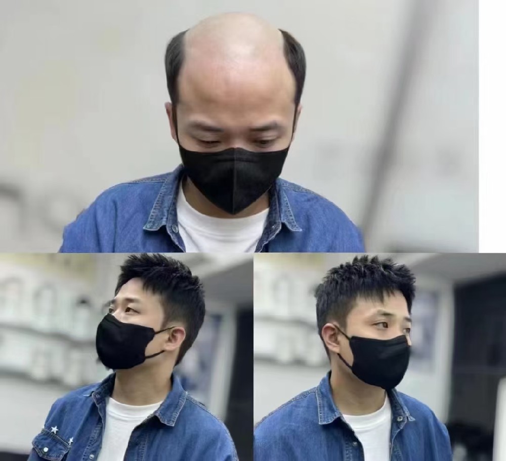 南阳脱发困扰？别只依赖食补，快速找回自信还有更直接的方法