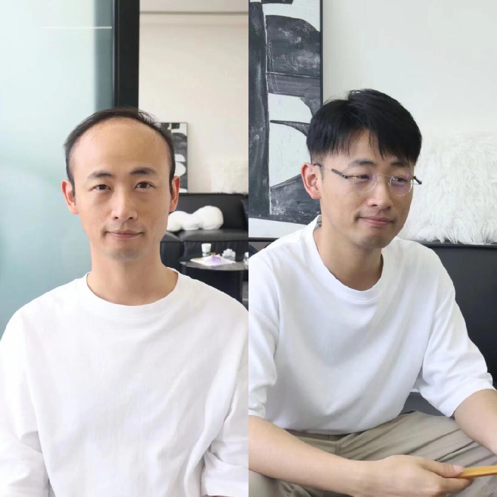 南阳脱发困扰不止，除了食补，还有更直接的解决方案