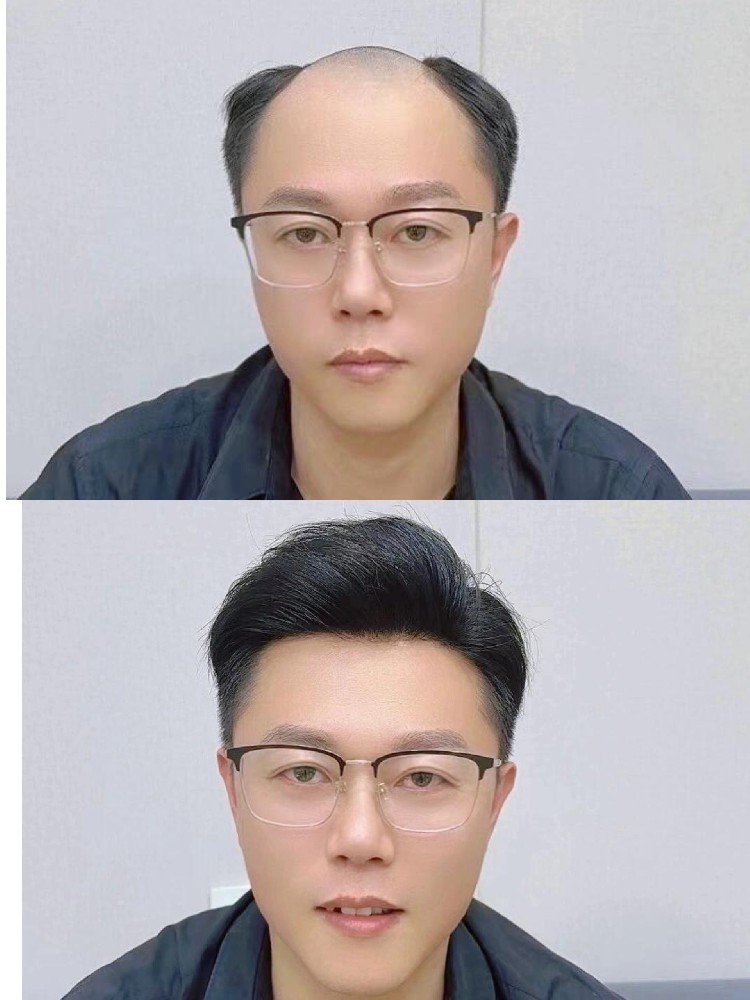 南阳男士头发稀疏困扰？试试这种自然高效的解决方案