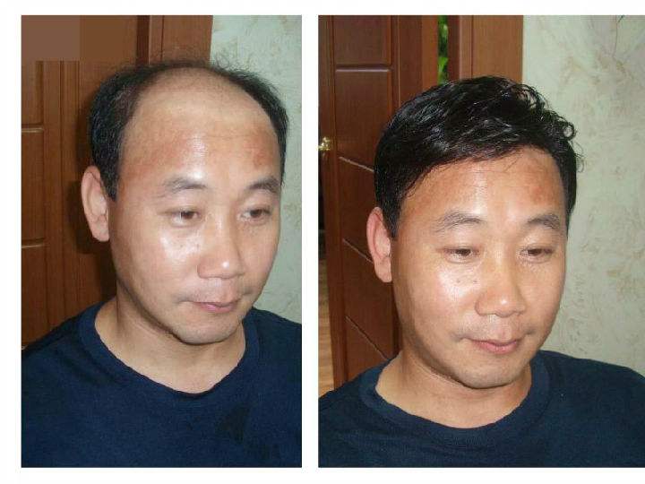 南阳头发稀疏怎么办？补发定制服务助您找回自信