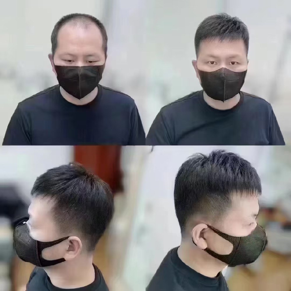 脱发早发现但难逆转？本地真实案例告诉你“补”才是硬道理