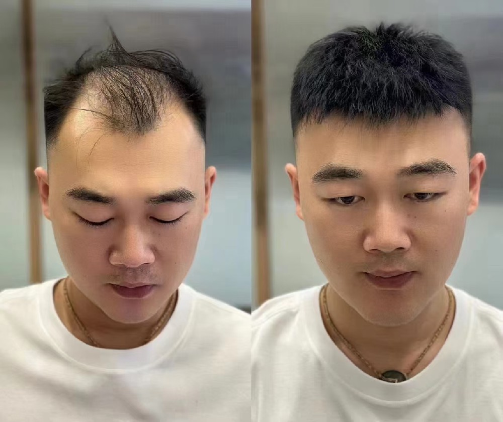 别让“化学伤害”再背锅，安全透气的真发补发才是正解