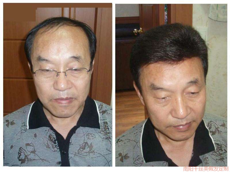 头顶上的烦恼：南阳千丝美，为男性脱发解忧