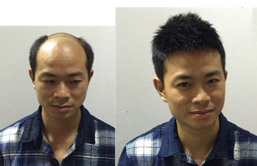 南阳头发稀疏不用等！千丝美假发定制：一小时戴上自然头，上班见客户不尴尬