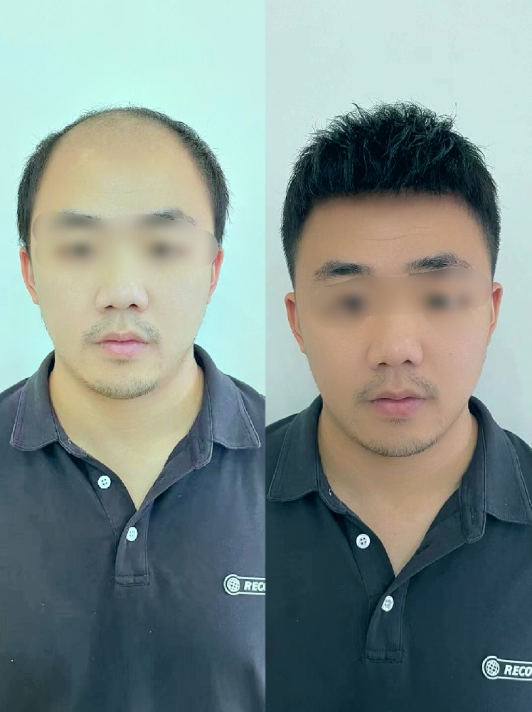 南阳头发稀疏别硬扛！千丝美定制假发：像量体裁衣一样，给您一份妥帖的安心