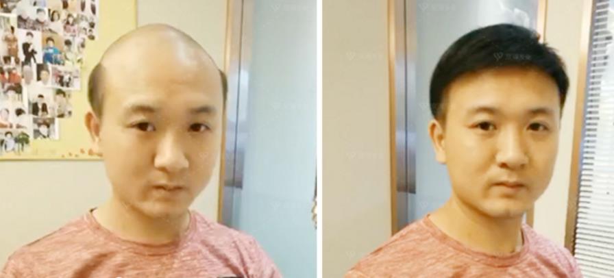 南阳遗传性脱发不用愁，千丝美补发假发定制中心来帮您