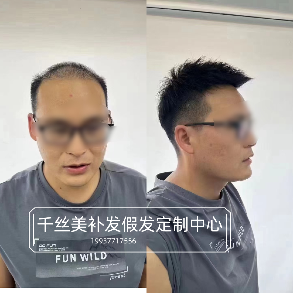 南阳假发真实案例：男士女士脱发怎么办？推荐南阳千丝美补发假发定制中心