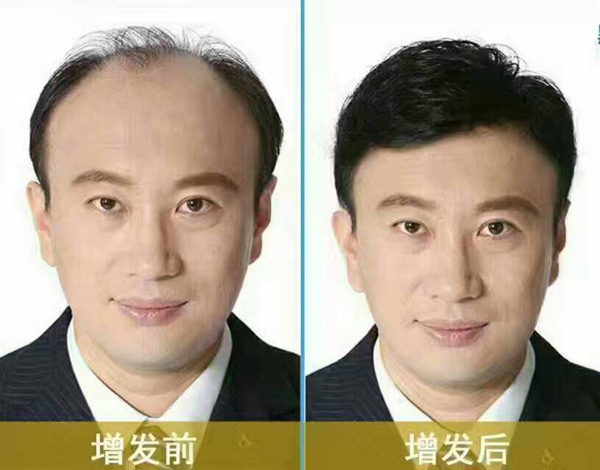 一位南阳补发师傅的真心话：只有懂脱发的苦，才能做出真正自然的好假发