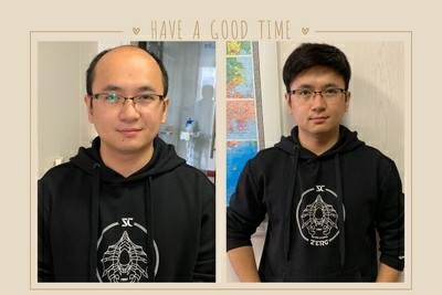 南阳假发定制：与其纠结毛囊，不如先让自己好看起来